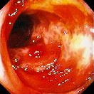 ISCHAEMIC COLITIS