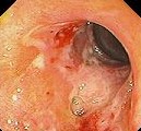 NSAID COLITIS 