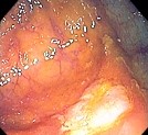 NSAID COLITIS