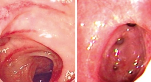 OLD AGE COLITIS - DIVERTICULOSIS
