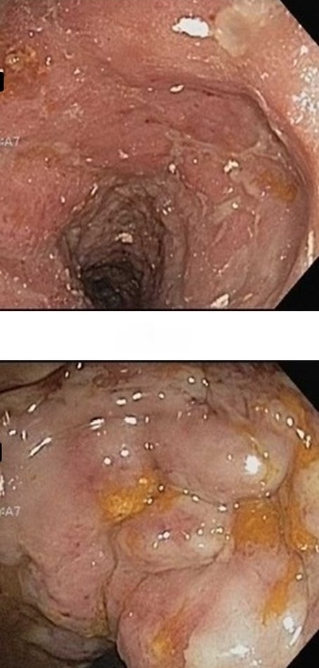 PSEUDOMEMBRANOUS COLITIS 