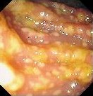 PSEUDOMEMBRANOUS COLITIS