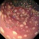 PSEUDOMEMBRANOUS COLITIS