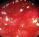 SALMONELLA COLITIS