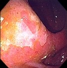 SALMONELLA COLITIS 