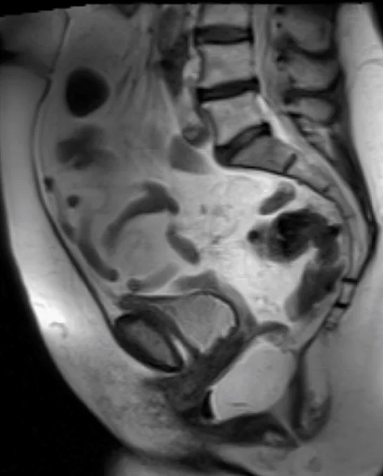 ANTERIOR RECTOCELE