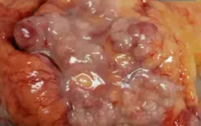 NEUROENDOCRINE COLONIC CARCINOMA