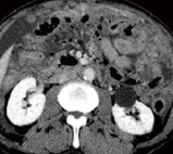 MALIGNANT MESOTHELIOMA