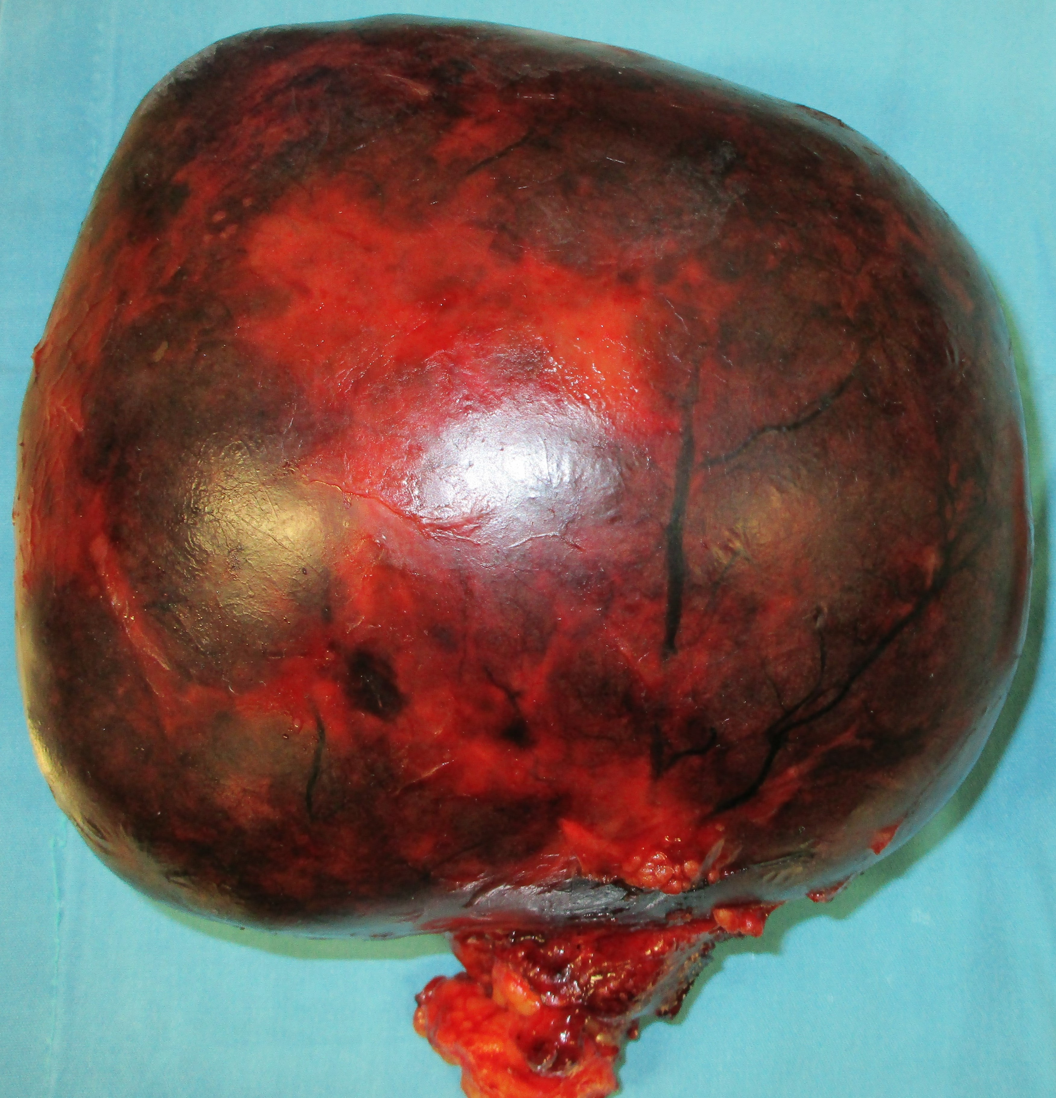 PRIMARY PERITONEAL TUMOR - SPECIMEN