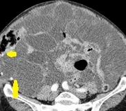 PSEUDOMYXOMA PERITONEI-APPENDICEAL MUCINOUS NEOPLASM