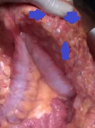 BENIGN MULTICYSTIC PERITONEAL MESOTHELIOMA 
