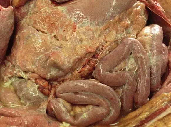 CHEMICAL PERITONITIS
