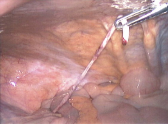 CONGENITAL BAND  VITELLINE ARTERY