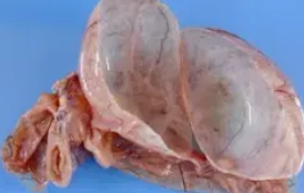 CYSTIC LYMPHANGIOMA