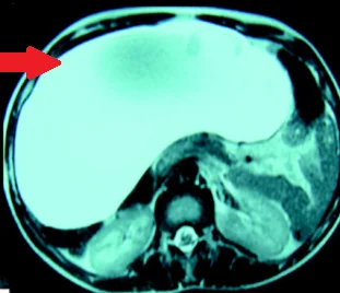 GIANT MESOTHELIAL CYST