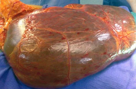 GIANT MESOTHELIAL CYST