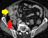 ILEAL NET - PERITONEAL DISSEMINATION