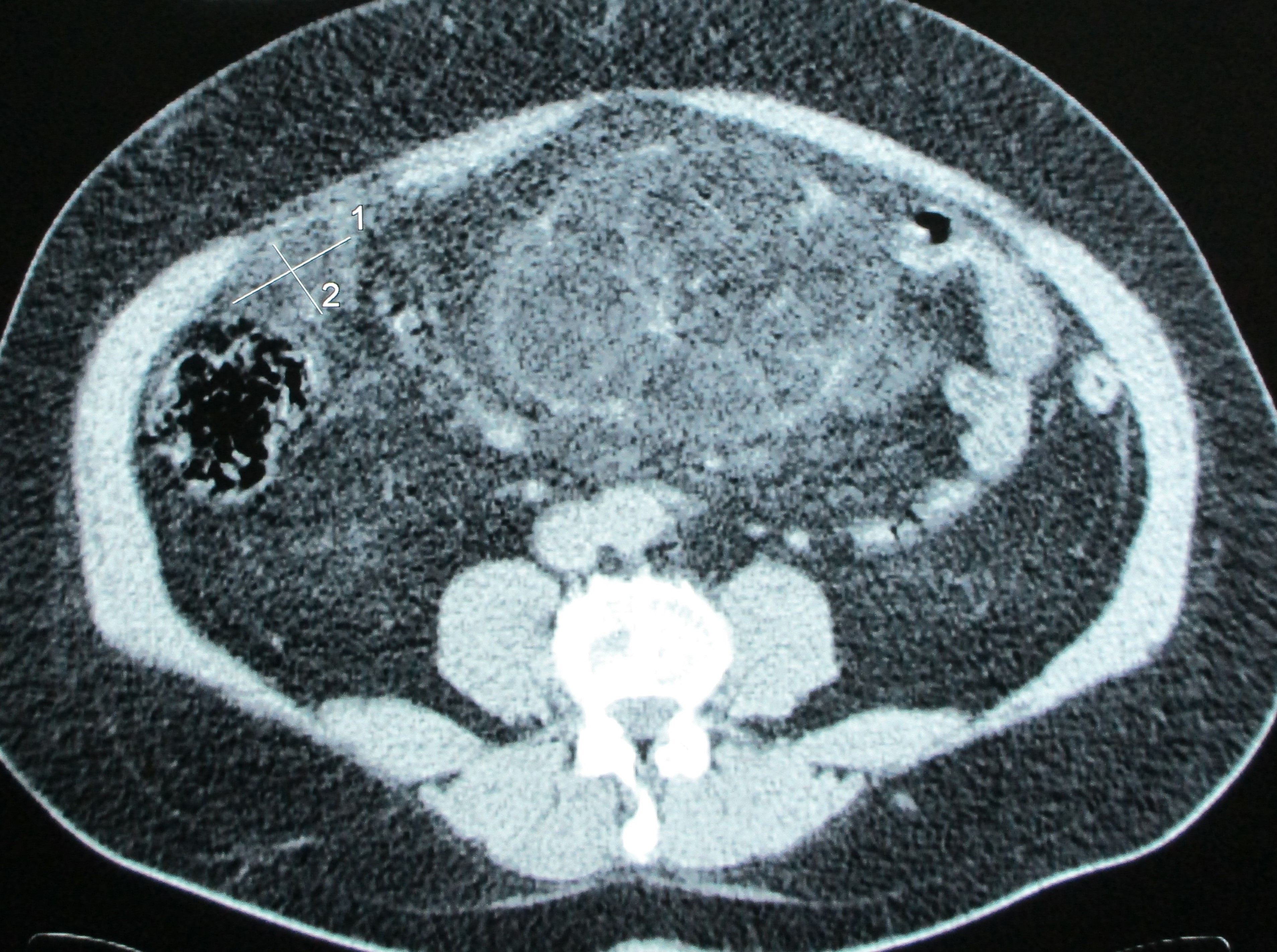 PRIMARY PERITONEAL TUMOR