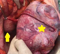 KRUKENBERG TUMOR