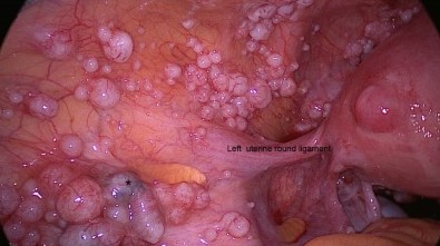 DISSEMINATED PERITONEAL LEIOMYOMATOSIS