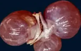 CYSTIC PERITONEAL LYMPHANGIOMA