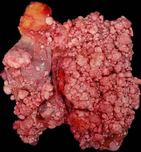 MALIGNANT MESOTHELIOMA