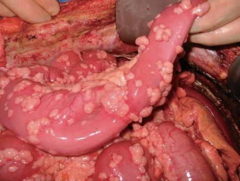 MALIGNANT MESOTHELIOMA 