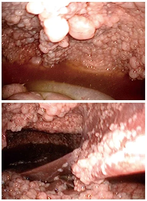 MALIGNANT MESOTHELIOMA
