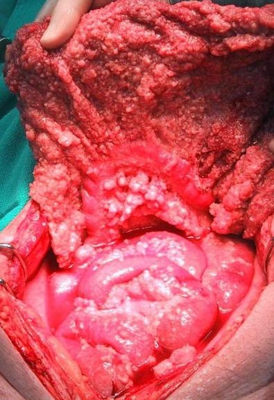 MALIGNANT PERITONEAL MESOTHELIOMA