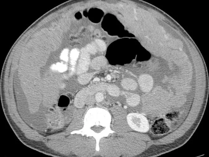 MALIGNANT PERITONEAL MESOTHELIOMA