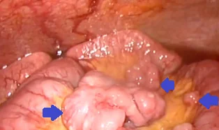 MALIGNANT SARCOMATOID PERITONEAL MESOTHELIOMA 