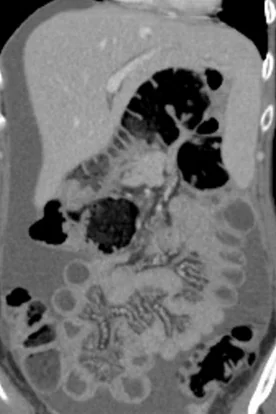 PERITONEAL CARCINOMATOSIS 