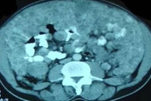 PERITONEAL STROMAL TUMOR