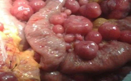PERITONEAL STROMAL TUMOR