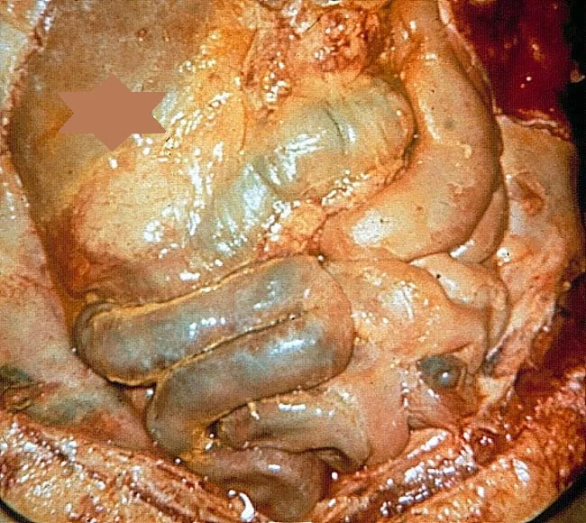 PERITONITIS