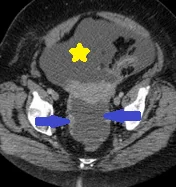 PRIMARY PERITONEAL SEROUS CARCINOMA