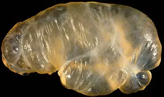 SOLITARY PERITONEAL CYST