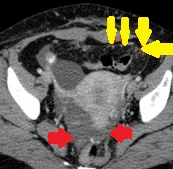 WELL DIFFERENTIATED PAPILLARY MESOTHELIOMA