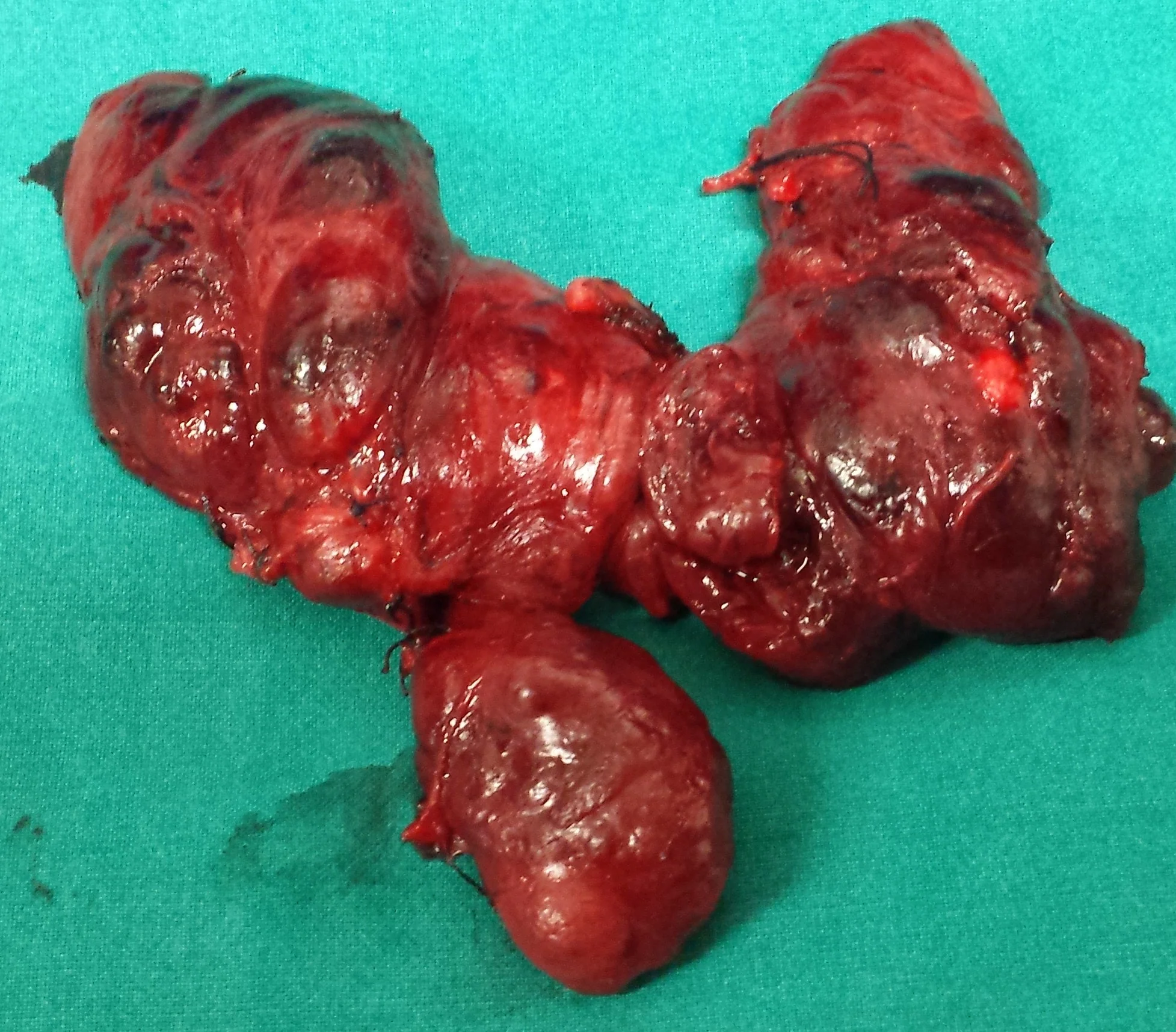 THYROID GOITER