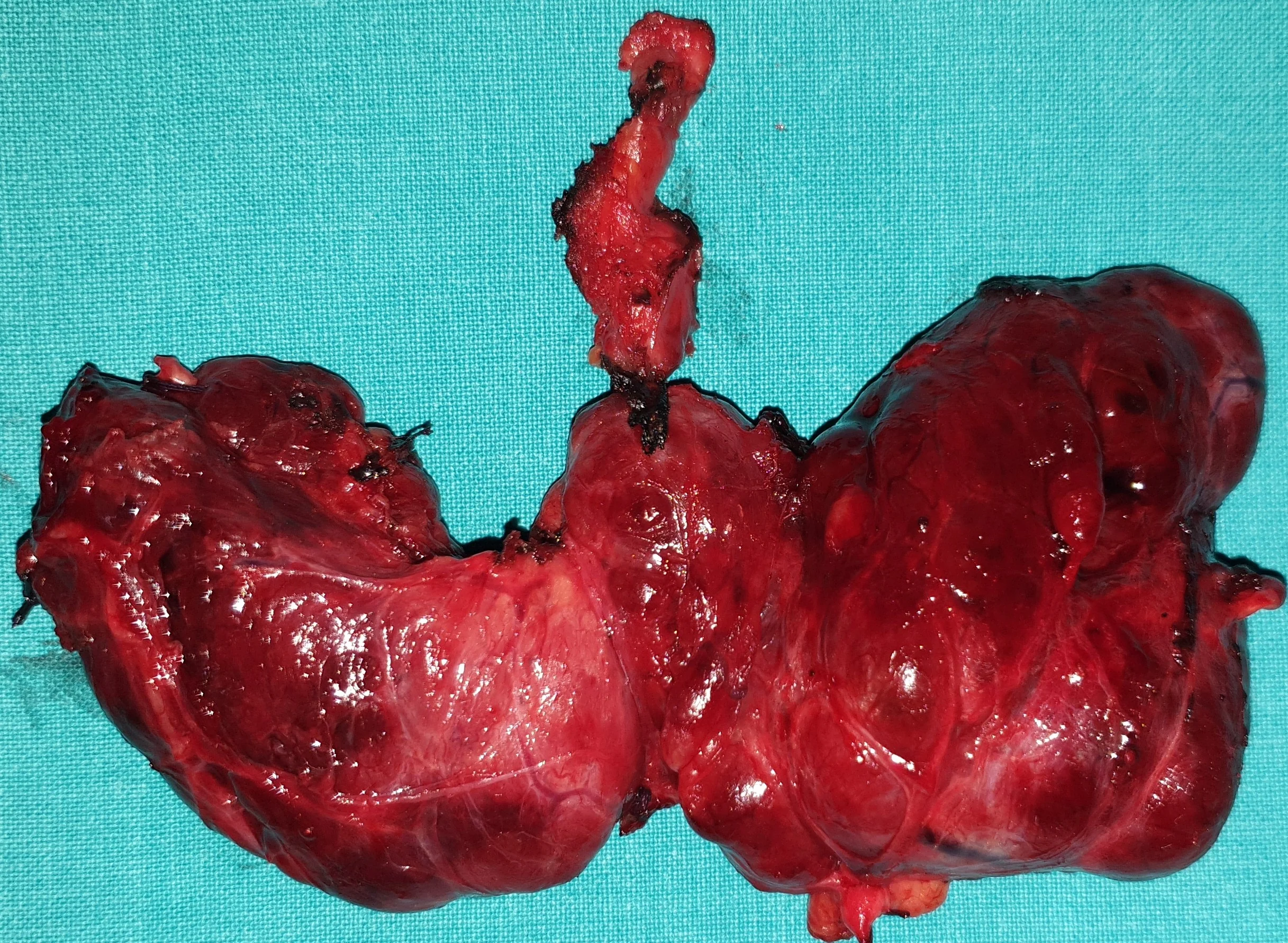 THYROID GOITER