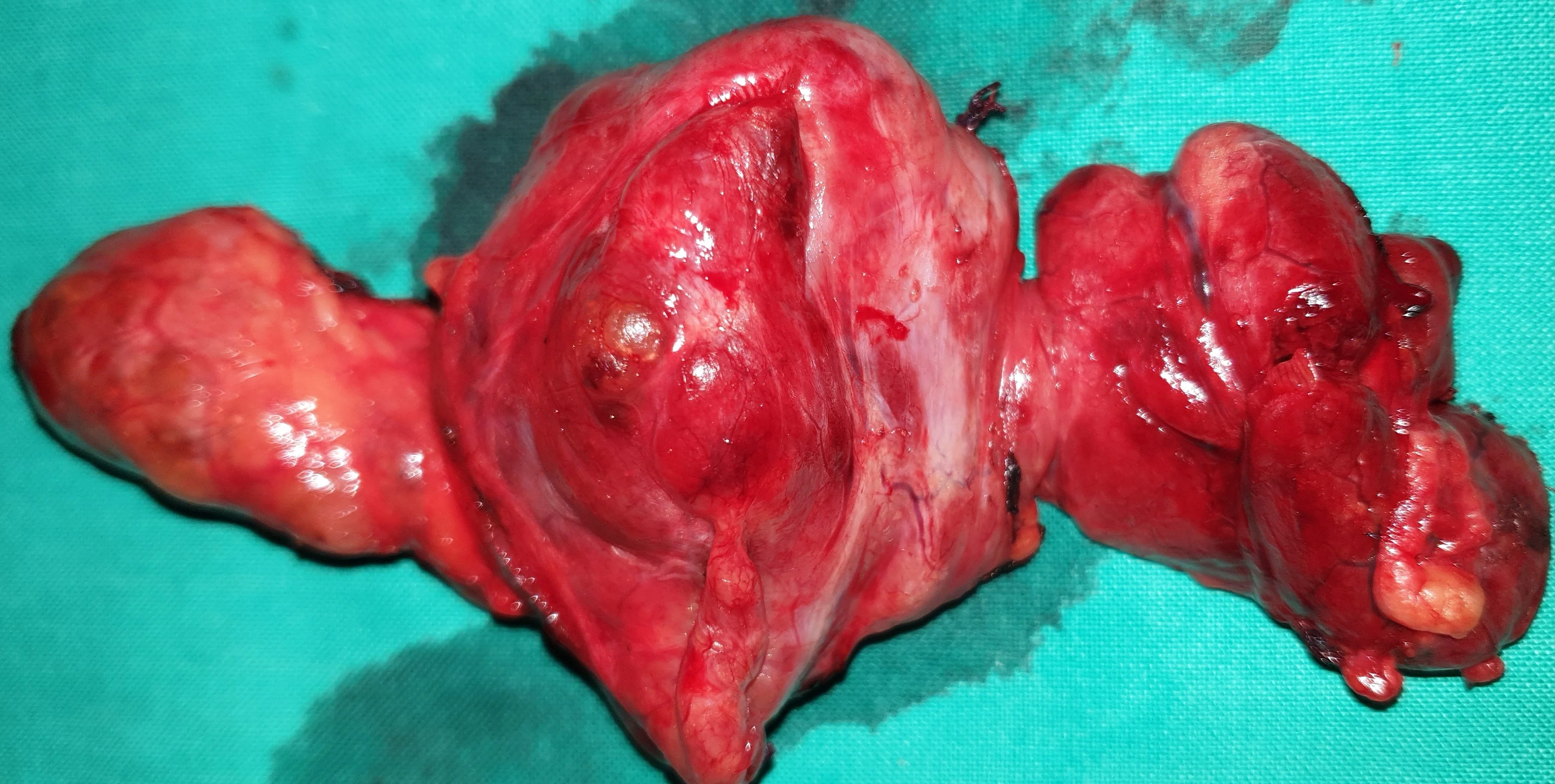 THYROID GOITER