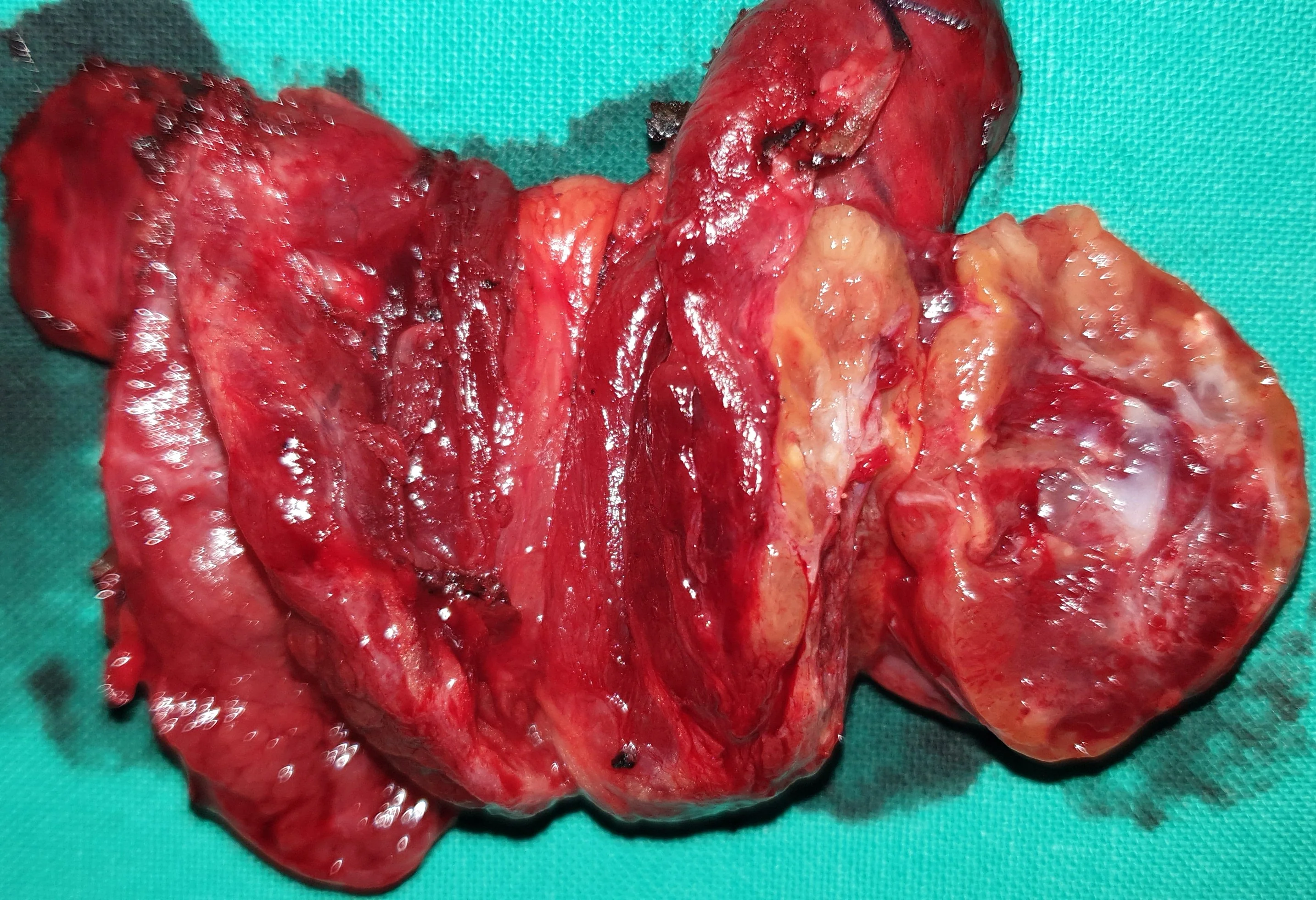 THYROID GOITER