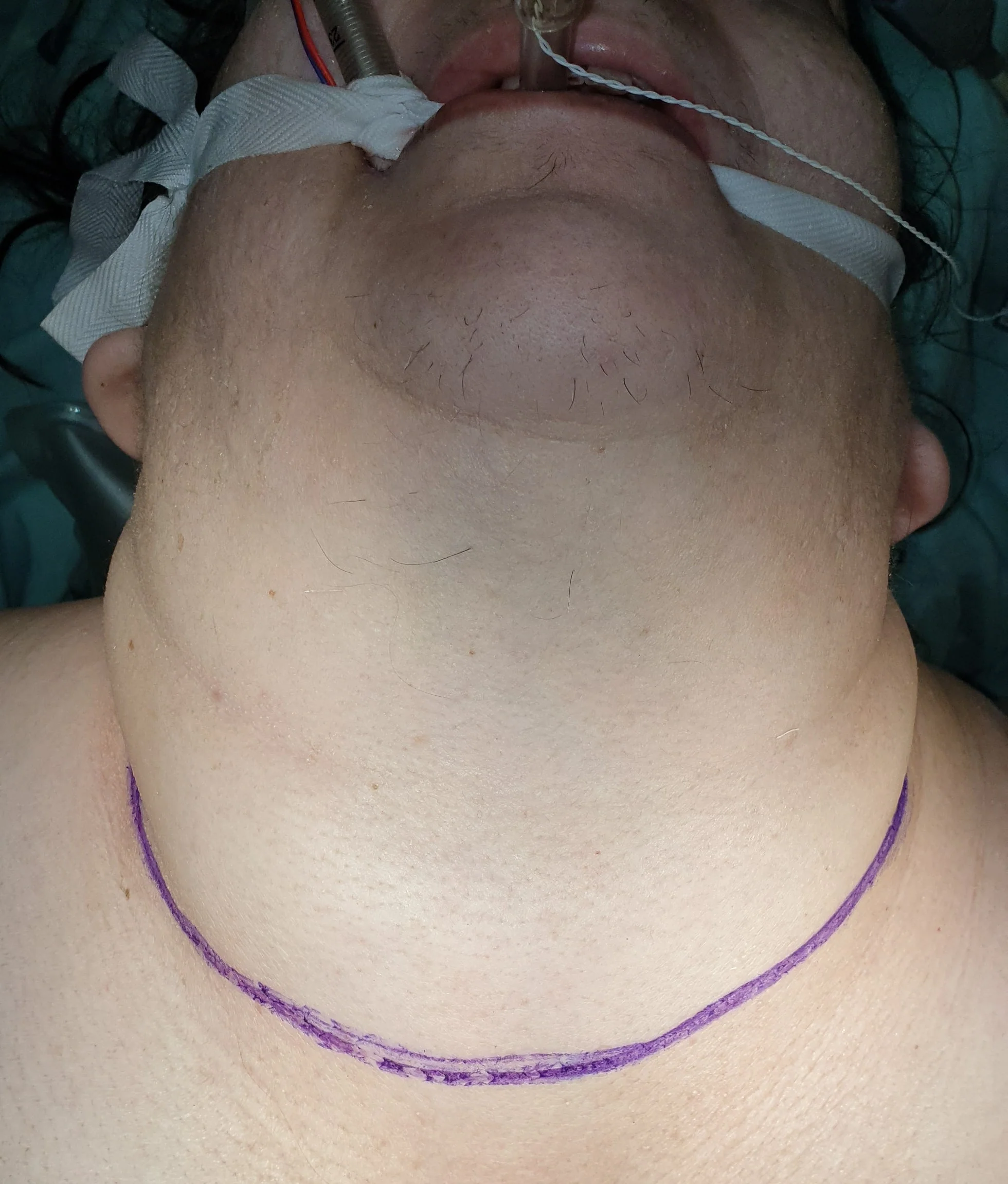 SIZEABLE THYROID GOITER