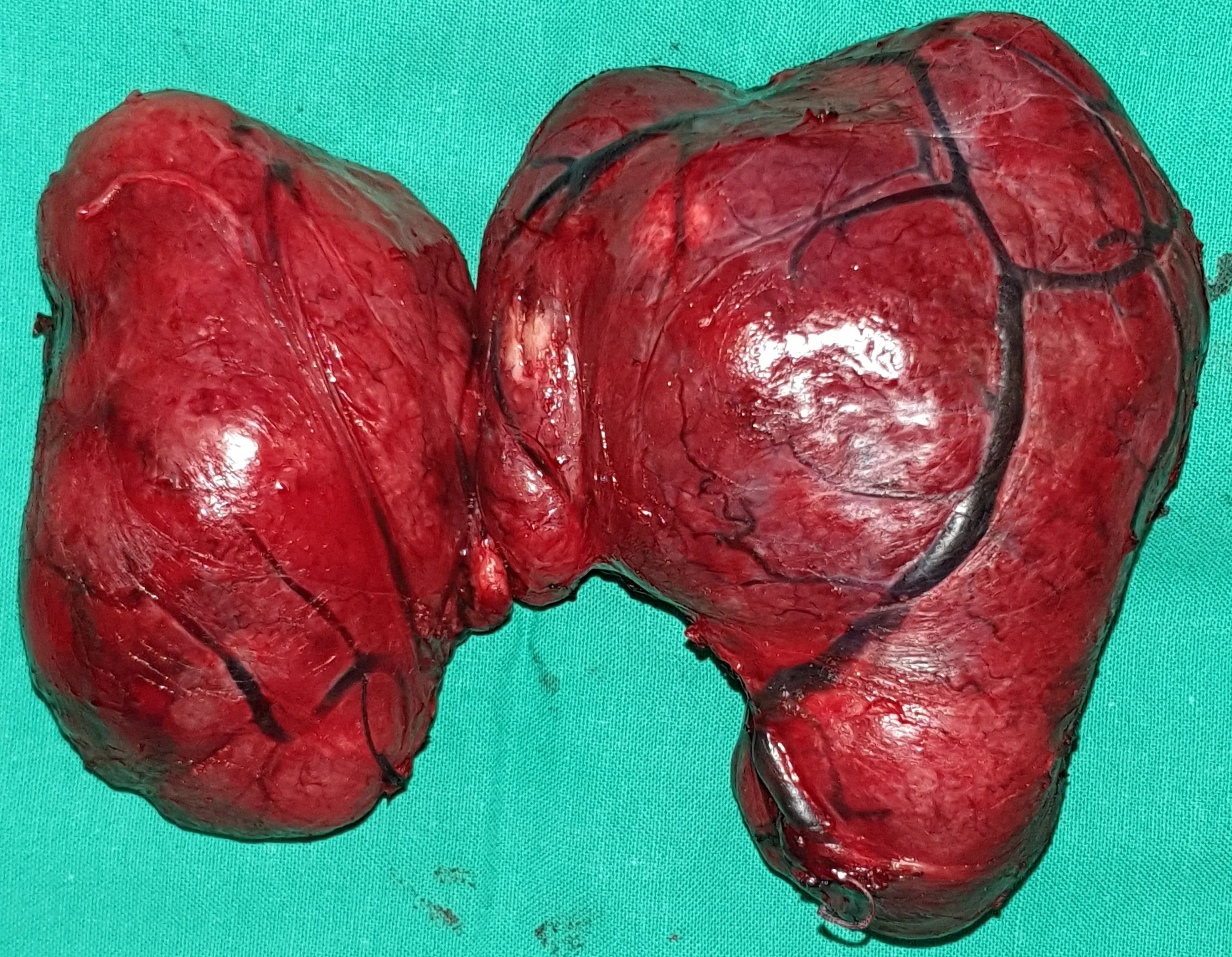 THYROID GOITER