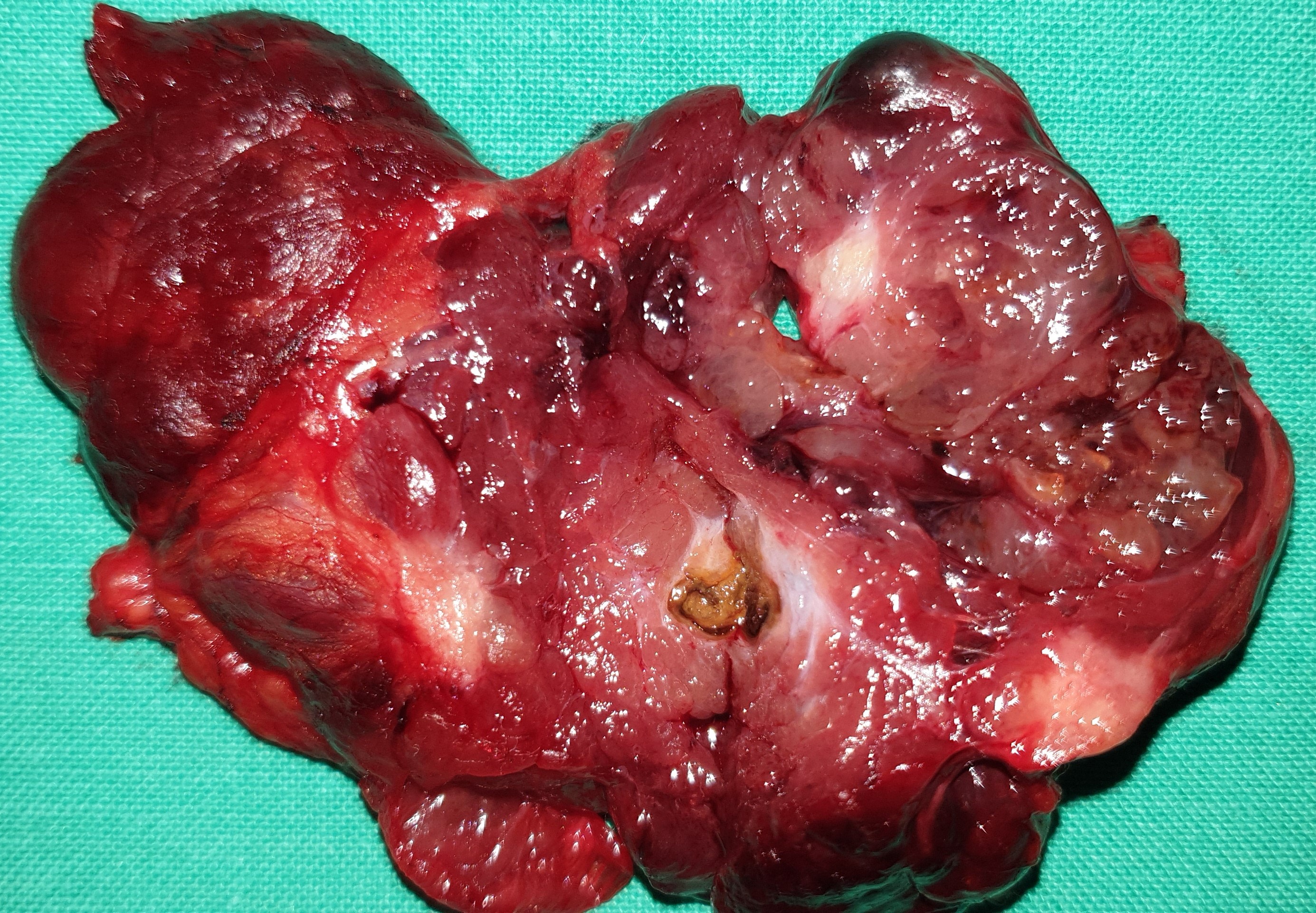PAPILLARY THYROID CARCINOMA
