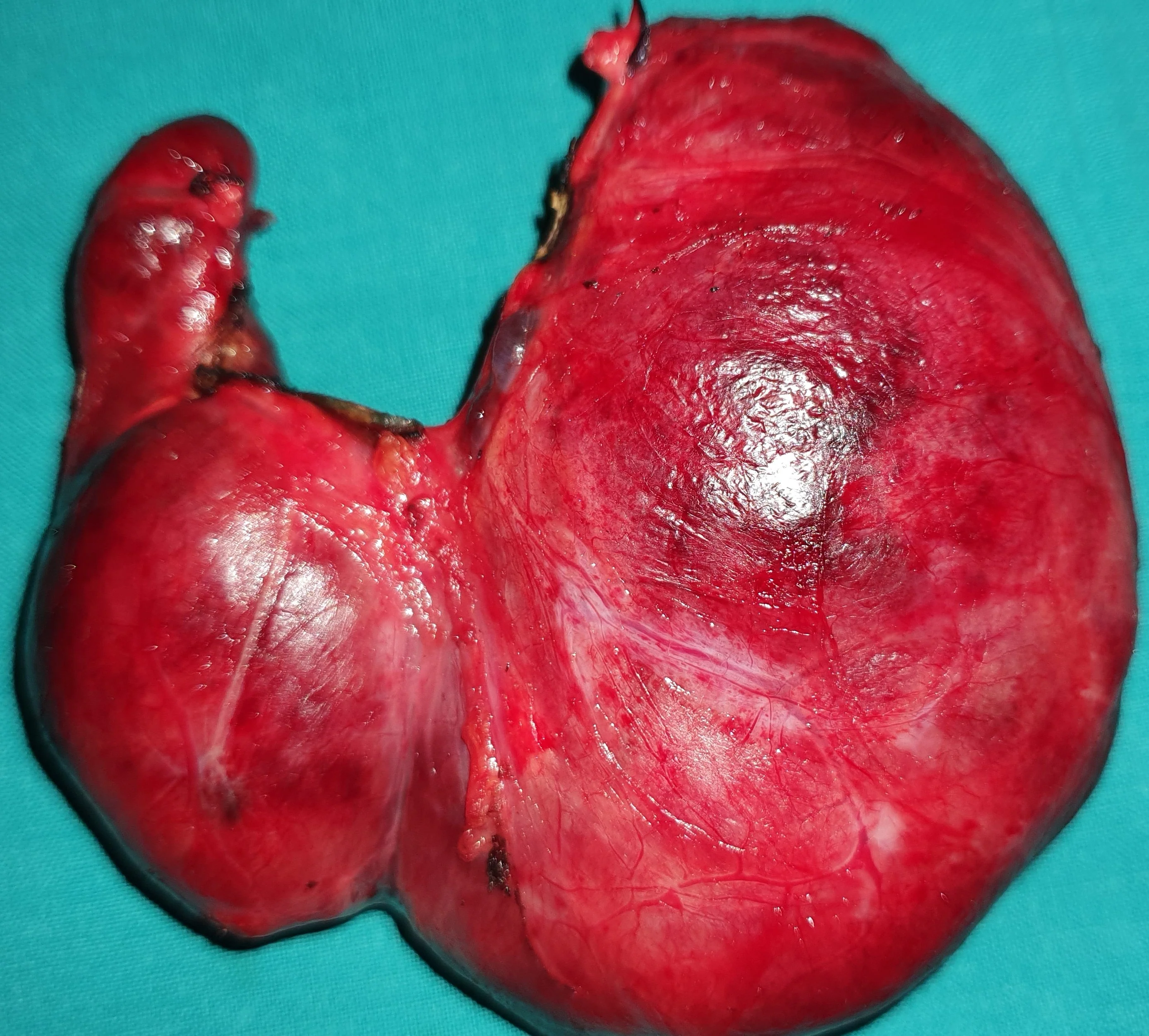 SIZEABLE THYROID GOITER