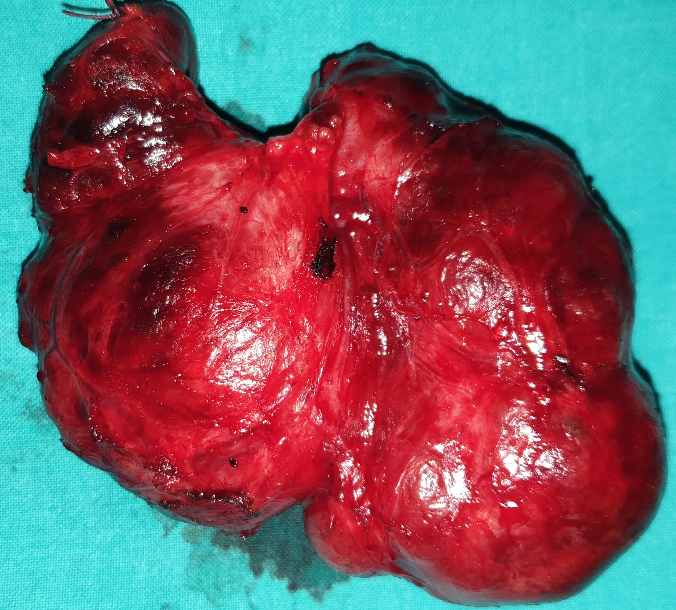 THYROID GOITER