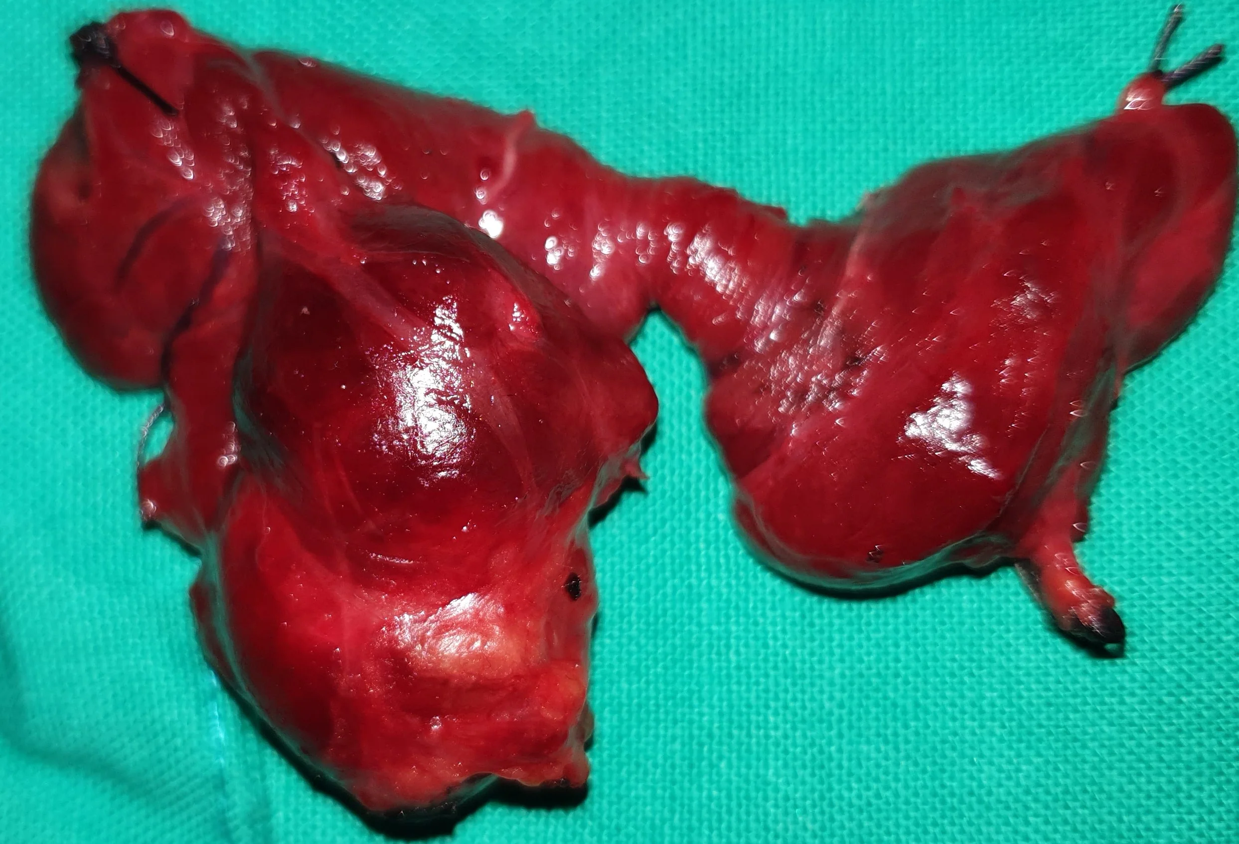 THYROID GOITER
