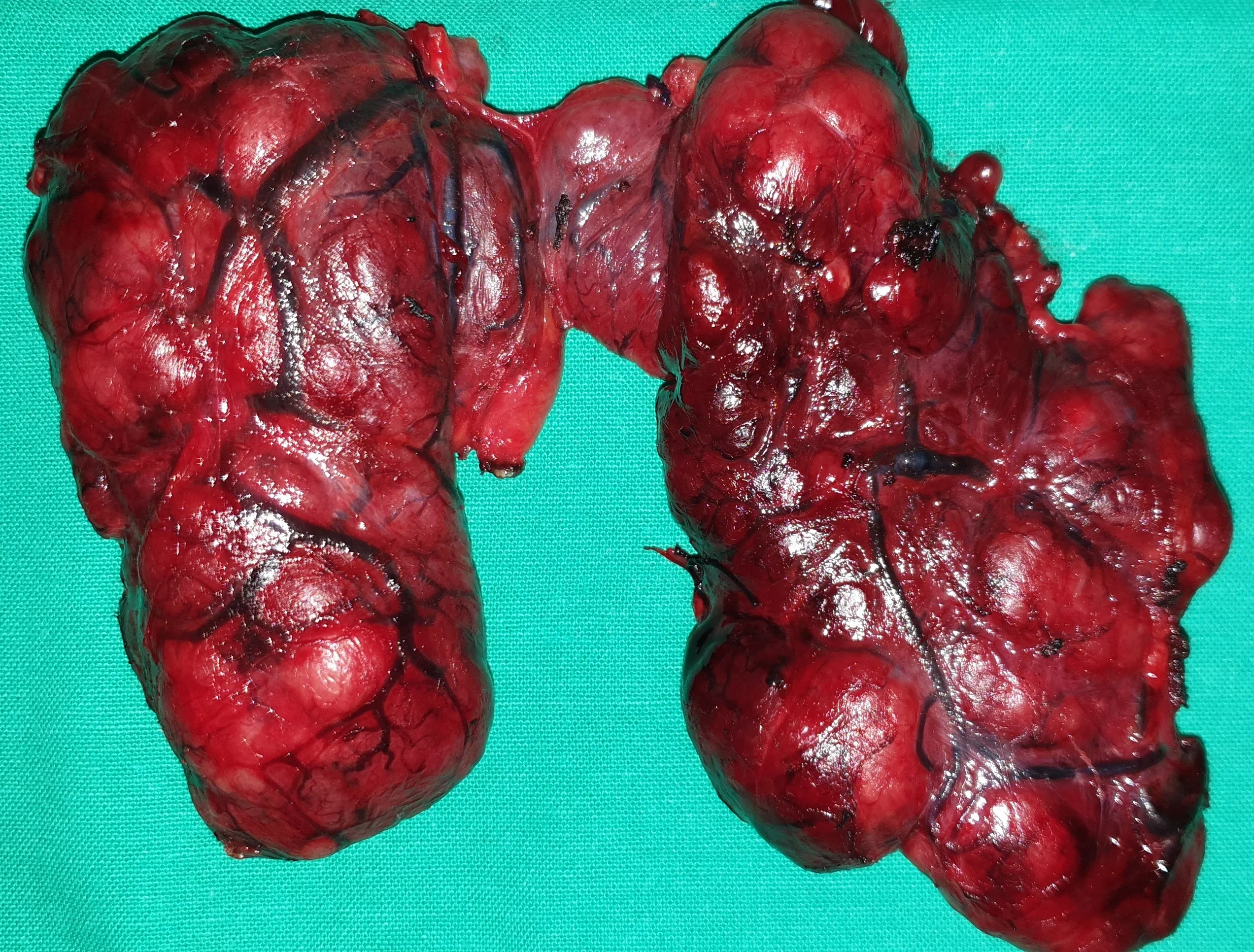 SIZEABLE THYROID GOITER
