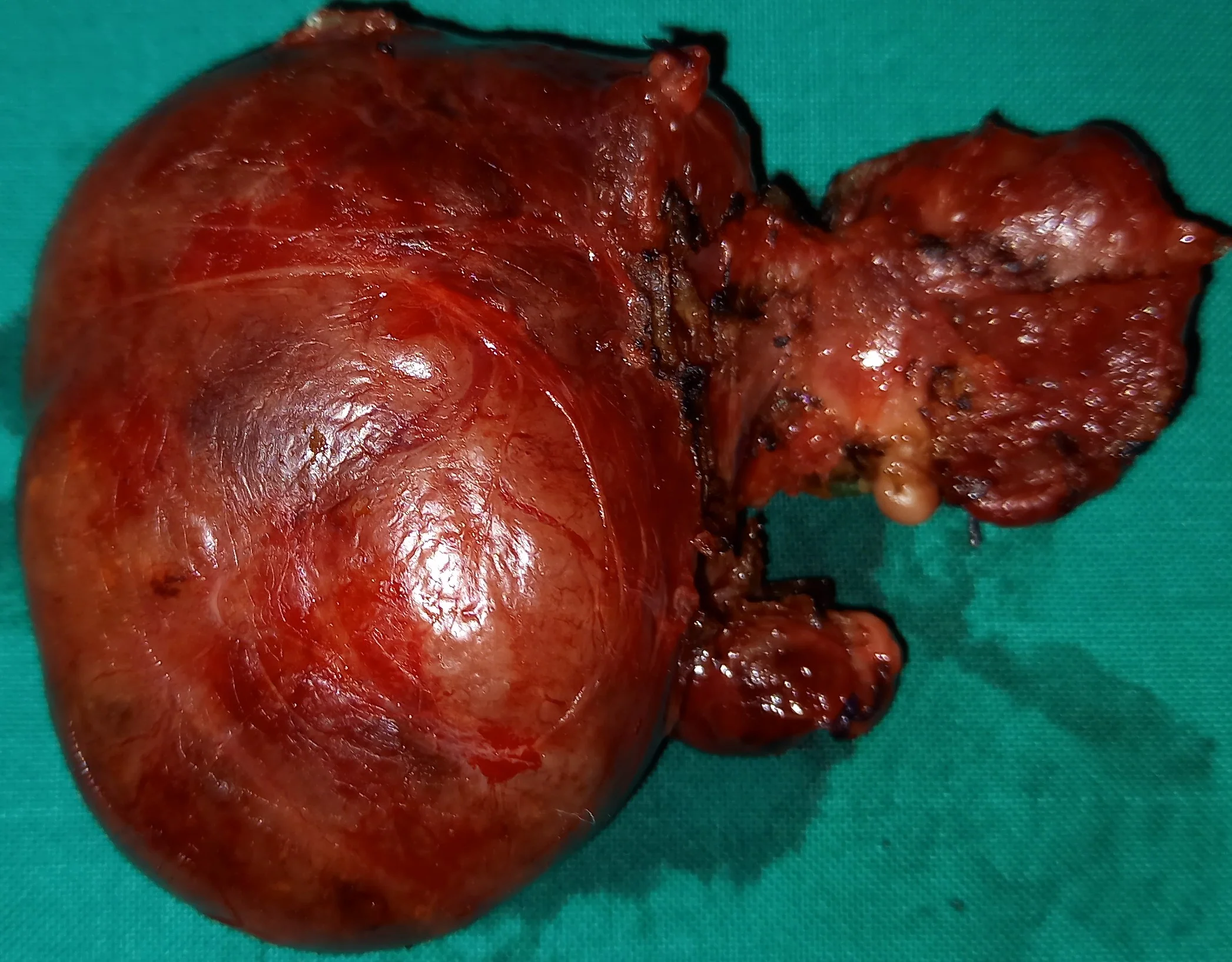 SIZEABLE RIGHT THYROID LOBE